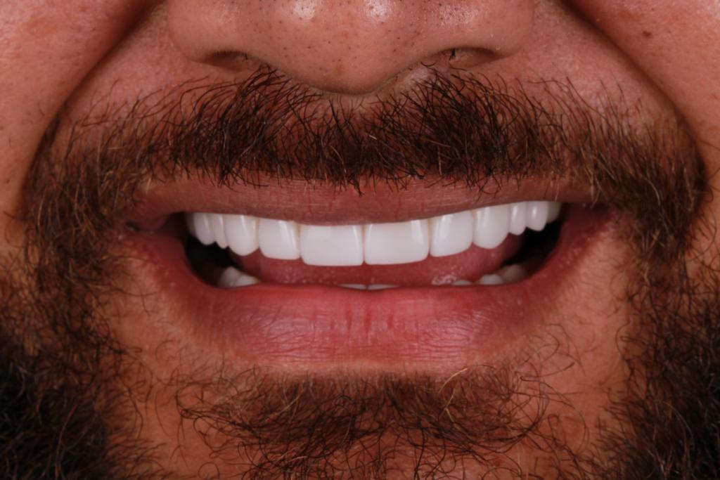 Después diseño dental